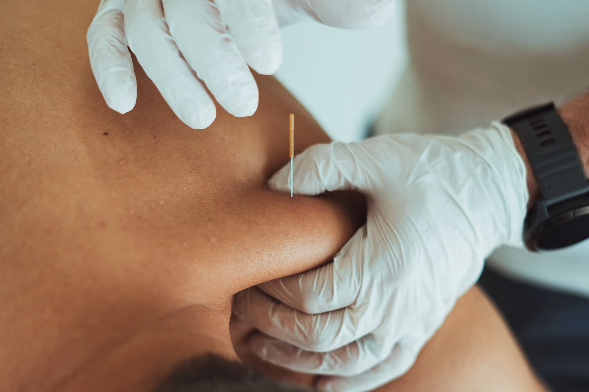 Dry Needling