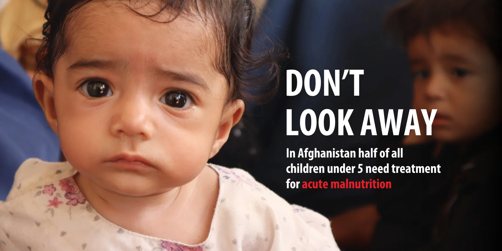 Malnurished child during availing H&N assistance Medair supported center in Southern Afghanistan