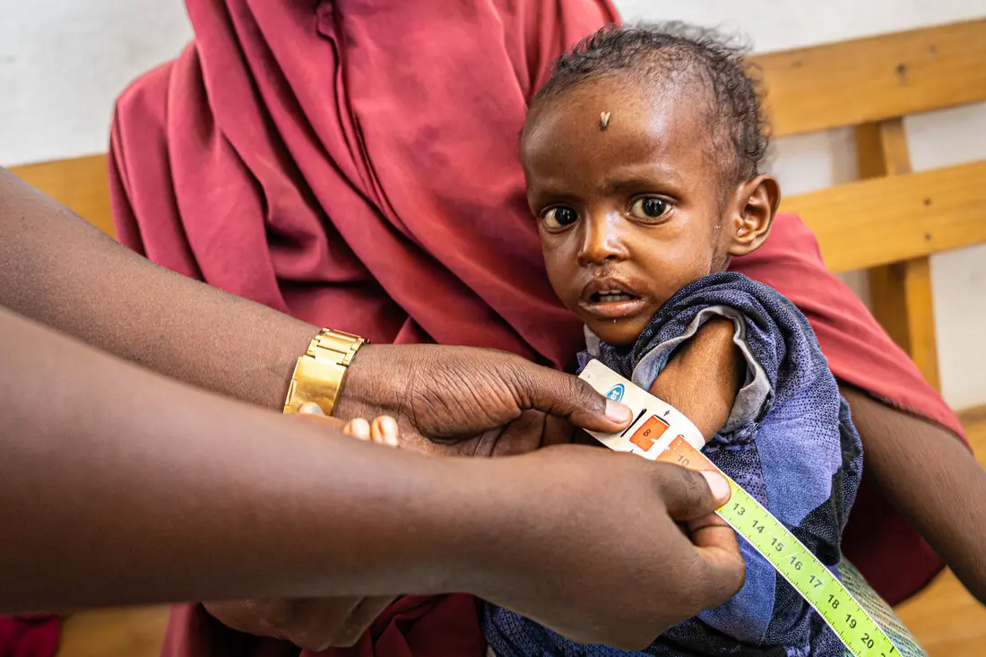 A girl gets screened for malnutrition with the MUAC-method in a health facility in southern Somalia.