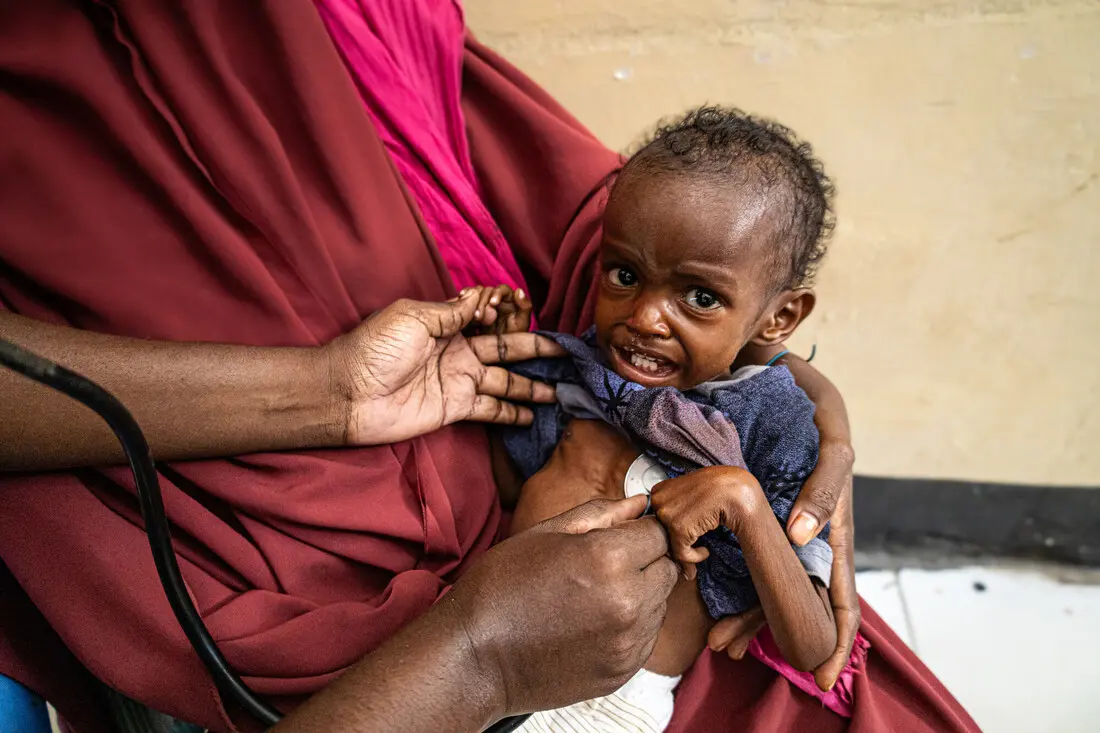 A health worker checks the heartbeat during the treatment of a one-year-old malnourished girl in a health facility in southern Somalia.