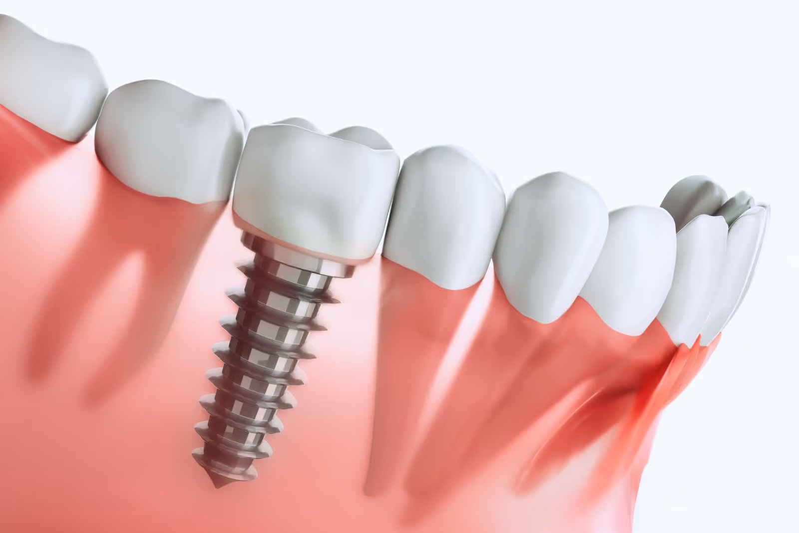 Dental Implants