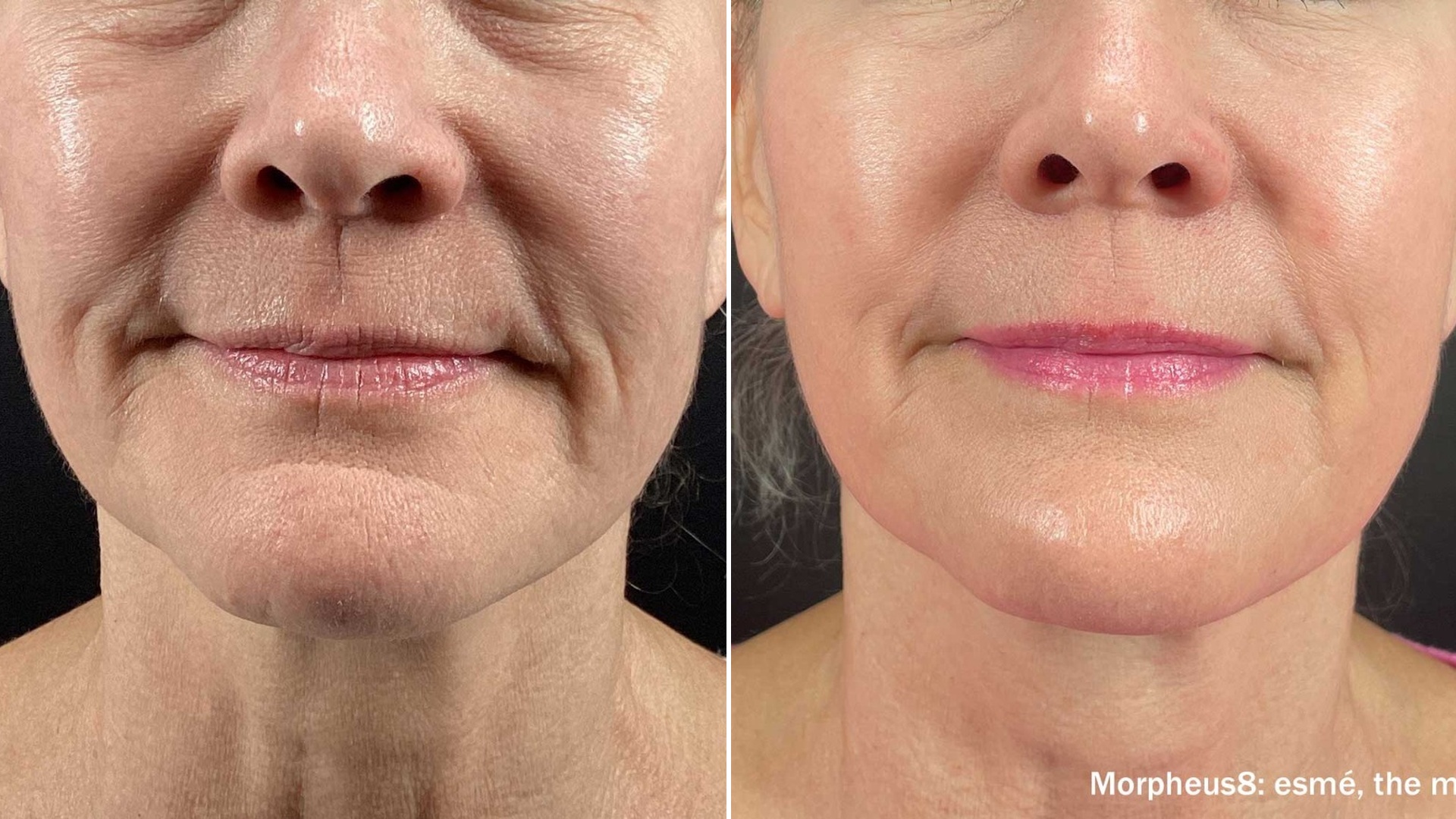 Smoother more refined texture result