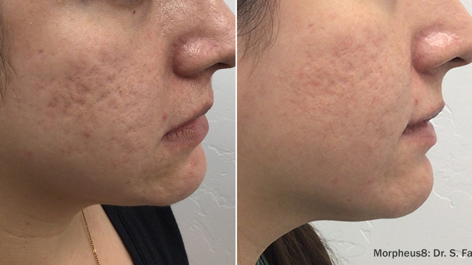 More refined facial definition result