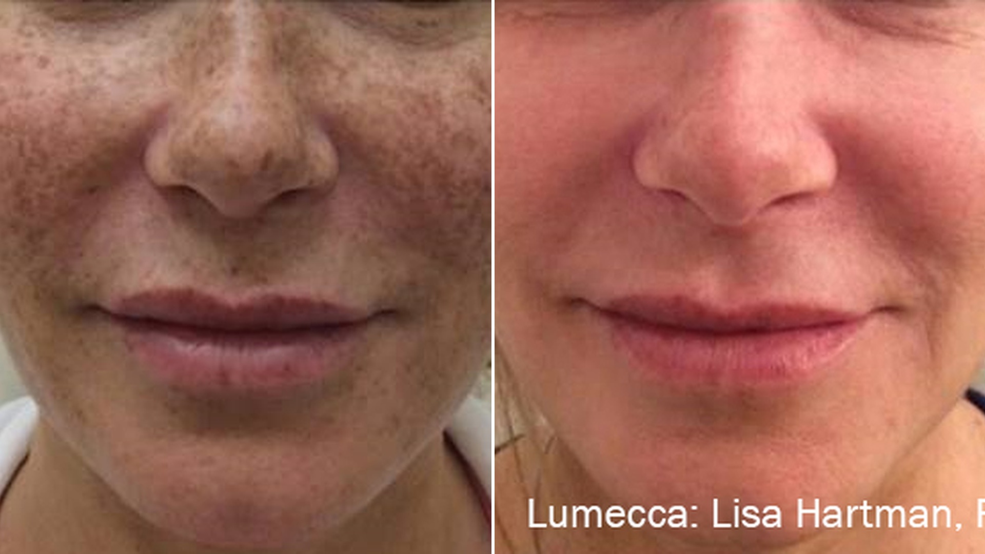 Improved tone and clarity result