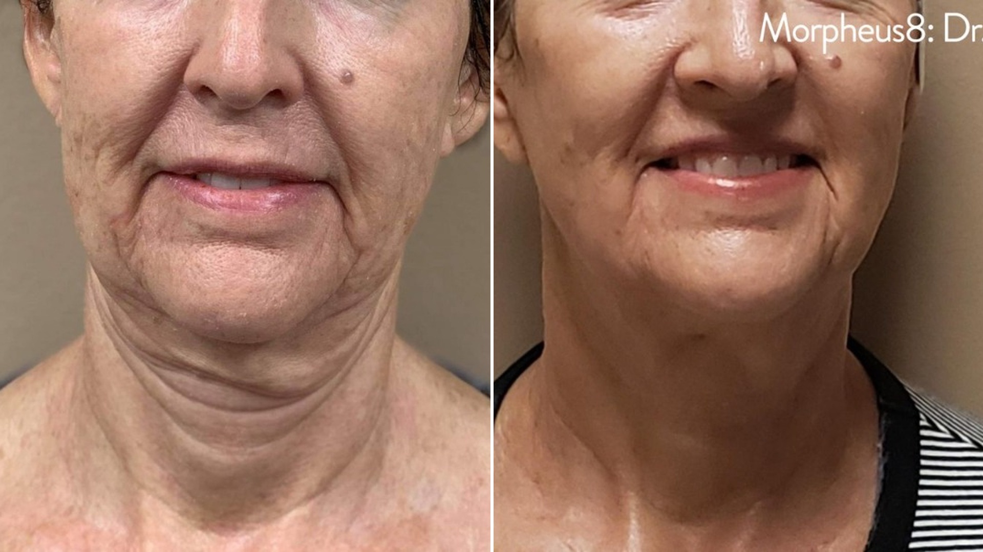 Jawline definition restored result