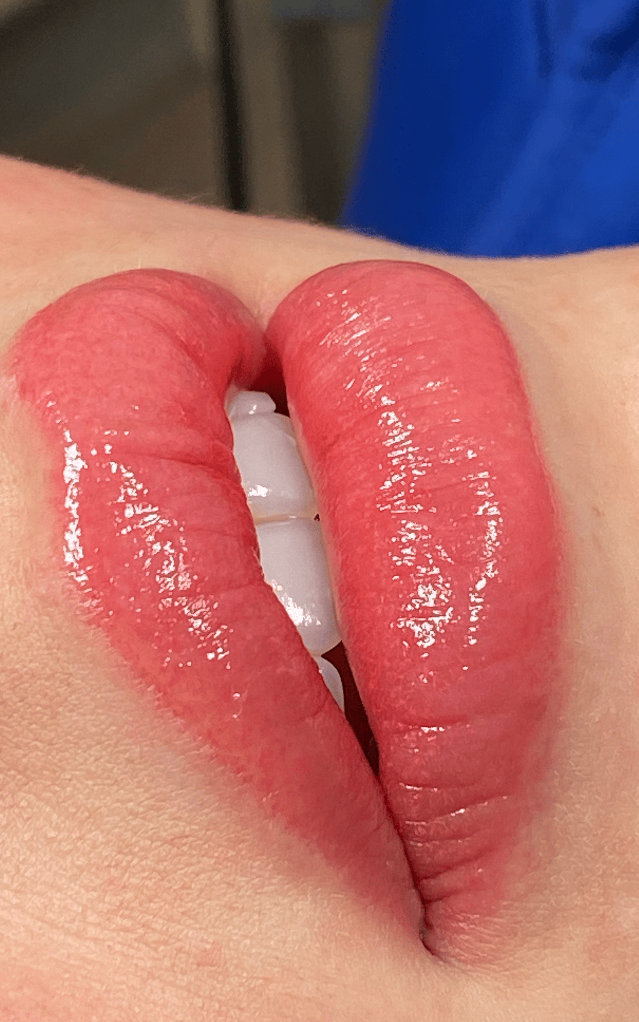 Healed Lip Blush result example