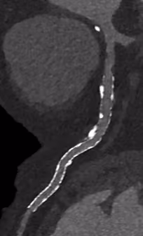 A blurry image that represents the quality derived from traditional CT
