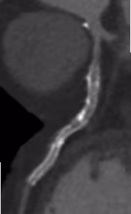 A blurry image that represents the quality derived from traditional CT