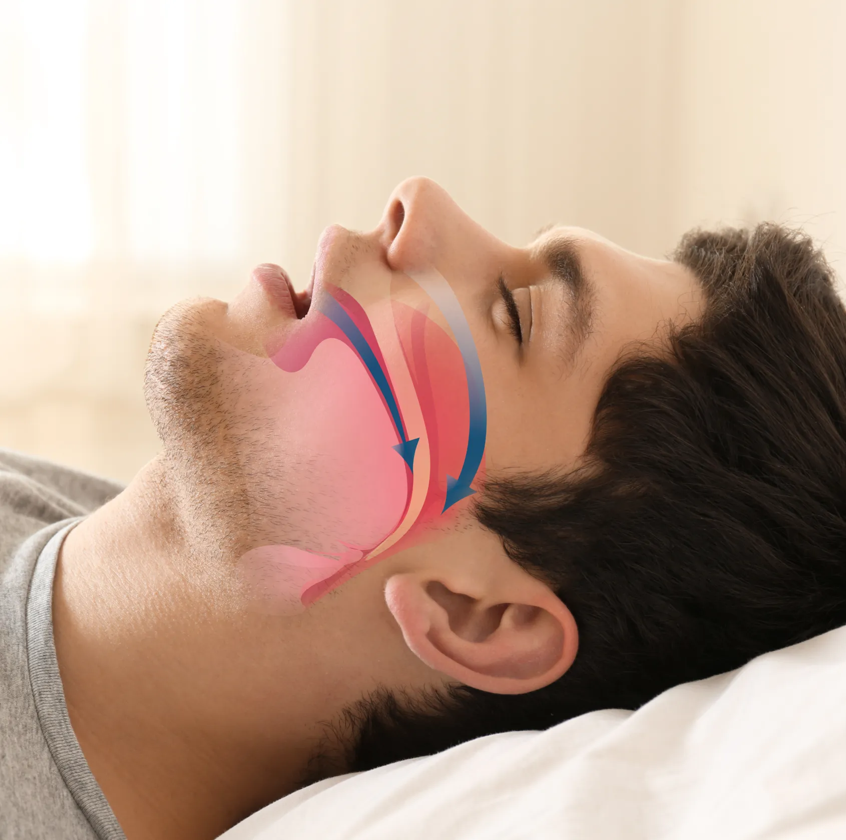 Sleep Apnea