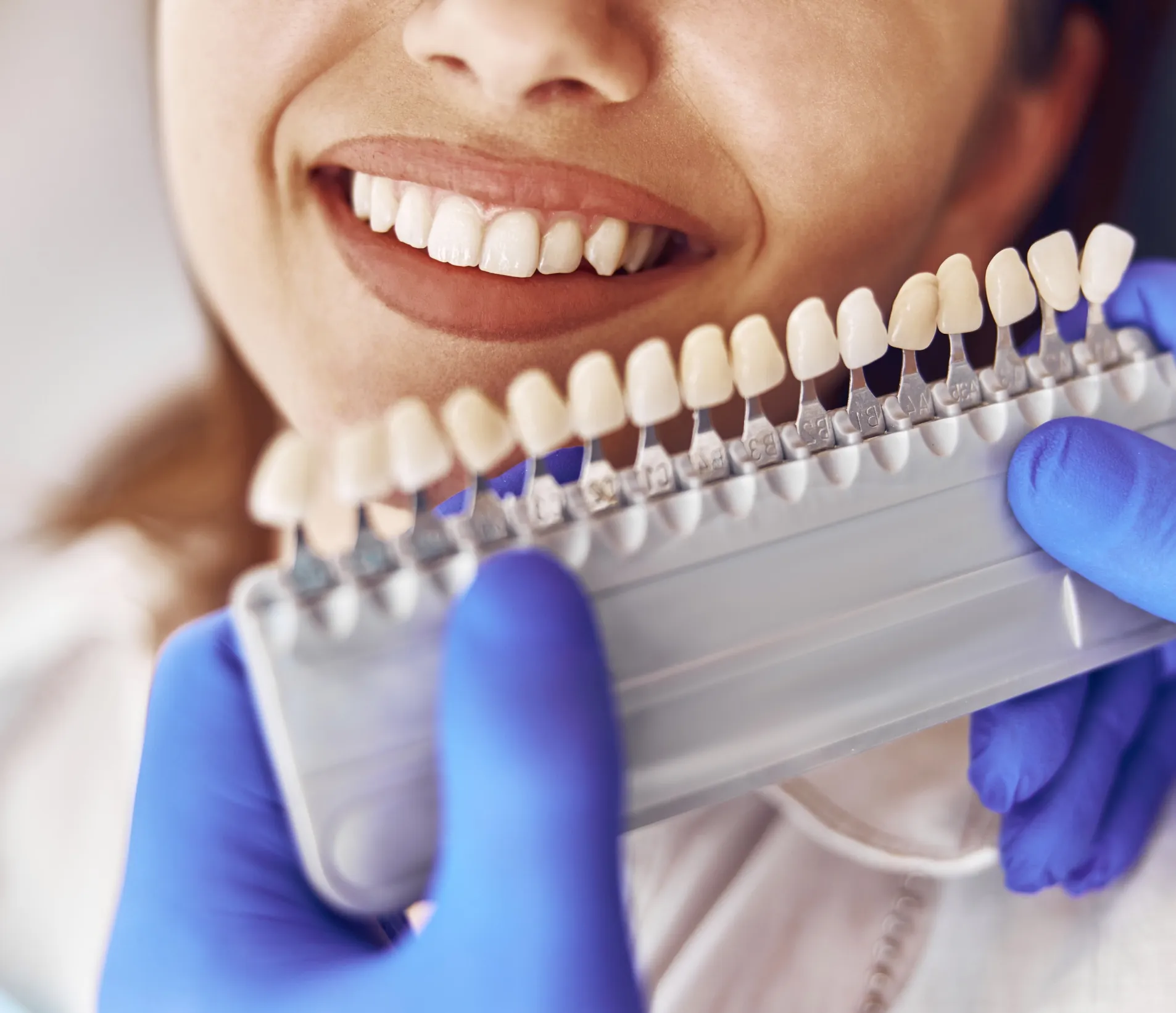 Person smiling showing teeth while a gloved hand holds a dental shade guide for matching veneers at A-Z Dental Art Studio.