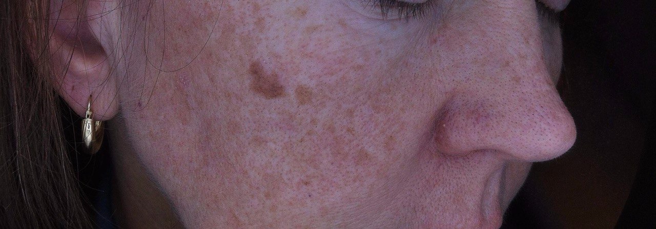 Etapy analizy skóry światłem UV w terapii przebarwień – od diagnostyki po odbudowę bariery hydrolipidowej