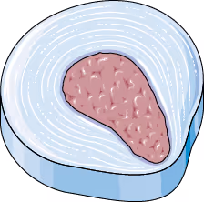 En medisinsk illustrasjon som viser et tverrsnitt av en mellomvirvelskive med den myke kjernen i midten. Illustrasjonen viser hvordan nukleus, den flytende geleaktige kjernen, presser annulus, den ytre ringen eller "skallet" utover ved en skivebukning. 