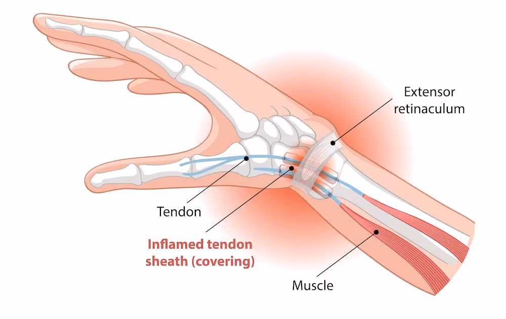 Anatomisk illustrasjon av et håndledd sett fra siden som viser hvordan abductor pollicis longus (APL) og extensor pollicis brevis (EPB) forløper fra underarmen og til sine fester på tommelen. Bildet viser et glødende område rundt håndleddet hvor seneskjeden typisk blir hoven og betent ved De Quervains seneskjedebetennelse.