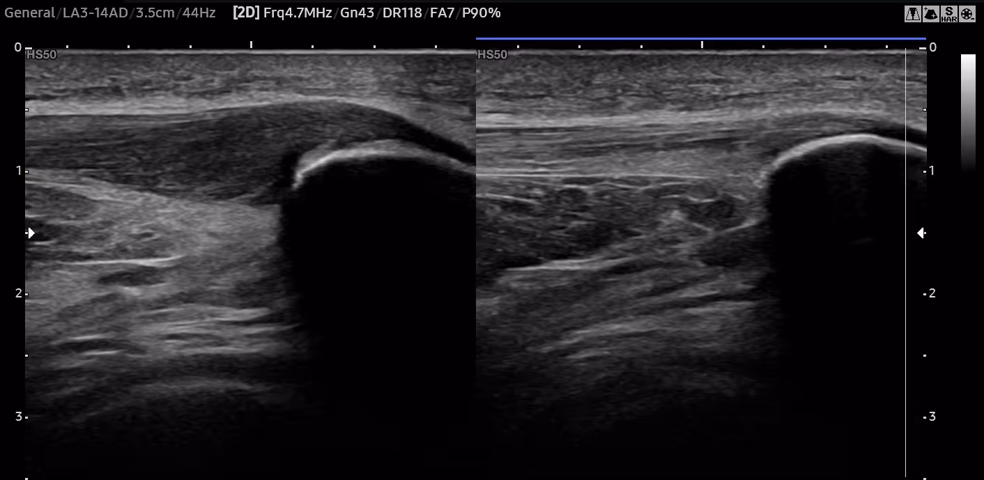 Ultralydbilde som viser en tendinopatisk patellarsene på venstre side av bildet, og en frisk og normal patellarsene på hø side. Senen på venstre side er tydelig tendinopatisk med fortykket struktur, endret ekkositet (farge) og viser en sone med sannsynlig ruptur av senen.