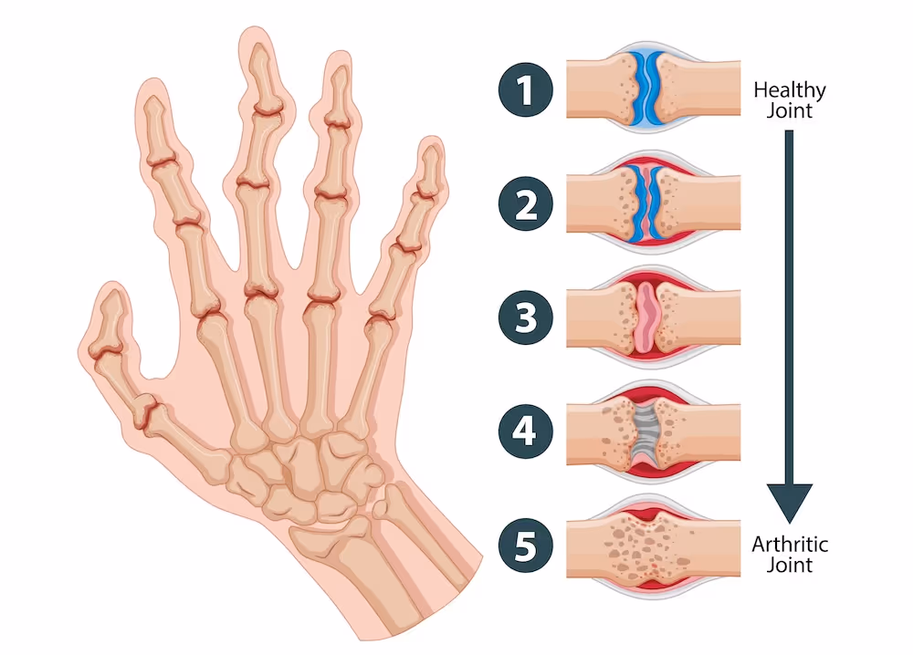 En medisinsk illustrasjon som viser utviklingen av artrose i en hånd. Til venstre ses en tegning av håndens anatomi med hovne og deformerte ledd. Til høyre vises en trinnvis guide i fem stadier: fra et friskt ledd (1) med intakt brusk, via økende betennelse og nedbryting (2–4), til et fullstendig ødelagt ledd (5) hvor knoklene gnisser mot hverandre.