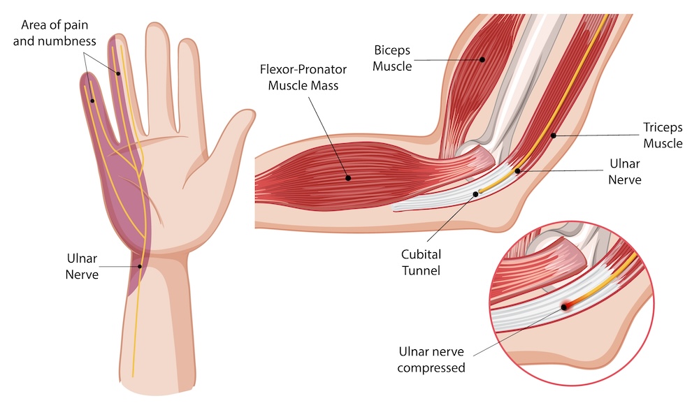 En medisinsk illustrasjon av en albue og hånd med ulnarnerve, muskelgrupper som viser de typiske smerteområdene yttersiden av hånden, i lillefinger og halve ringfinger ved kompresjon i cubitaltunnelen.