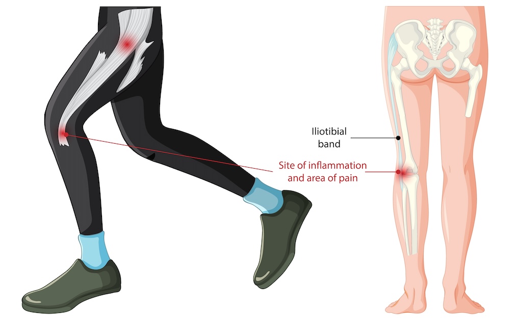 Medisinsk illustrasjon av løperkne i to deler. Til venstre ses en løper i profil med fokus på låret, der iliotibialbåndet er markert i hvitt med røde punkter som indikerer smerte ved hoften og kneet. Til høyre vises en anatomisk figur bakfra som viser hvordan båndet strekker seg fra bekkenet ned til utsiden av kneleddet.