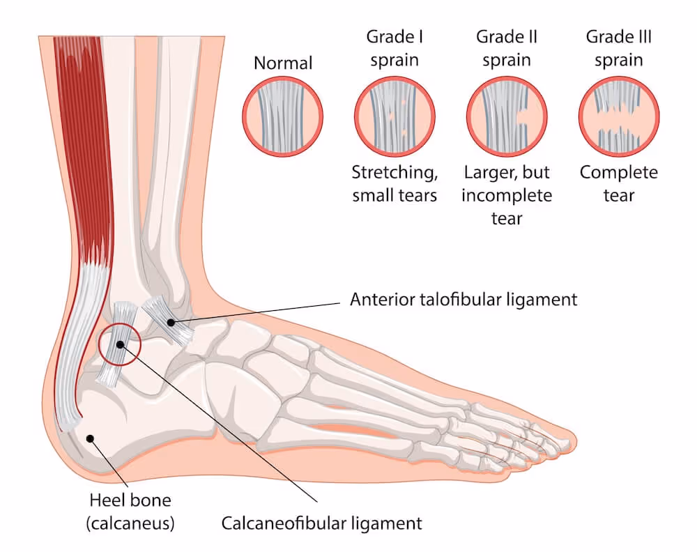 Medisinsk illustrasjon som forklarer ulike grader av leddbåndskader ved et overtråkk i ankelen. Hovedmotivet viser skjelettet i en fot fra siden med markeringer for fremre talofibularligament og calcaneofibularligamentet ved hælbenet. Øverst i bildet vises fire sirkulære detaljbilder som sammenligner et normalt leddbånd med grad én som har små rifter, grad to som har en større men ufullstendig avrivning, og grad tre som viser en fullstendig avrivning av leddbåndet.