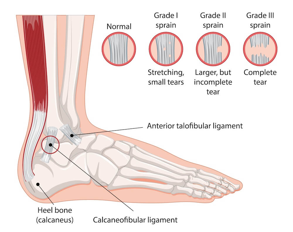 Medisinsk illustrasjon som forklarer ulike grader av leddbåndskader ved et overtråkk i ankelen. Hovedmotivet viser skjelettet i en fot fra siden med markeringer for fremre talofibularligament og calcaneofibularligamentet ved hælbenet. Øverst i bildet vises fire sirkulære detaljbilder som sammenligner et normalt leddbånd med grad én som har små rifter, grad to som har en større men ufullstendig avrivning, og grad tre som viser en fullstendig avrivning av leddbåndet.