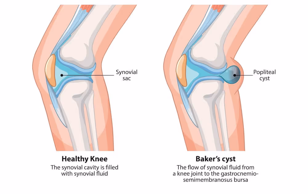 Medisinsk illustrasjon som sammenligner et friskt kne med et kne som har Bakers cyste, vist i profil. Den venstre figuren viser et friskt kne med en normal leddkapsel fylt med leddvæske, merket som "Synovial sac". Den høyre figuren viser hvordan leddvæske har strømmet ut og dannet en kul i knehasen, en såkalt Popliteal cyste eller Baker's cyste.