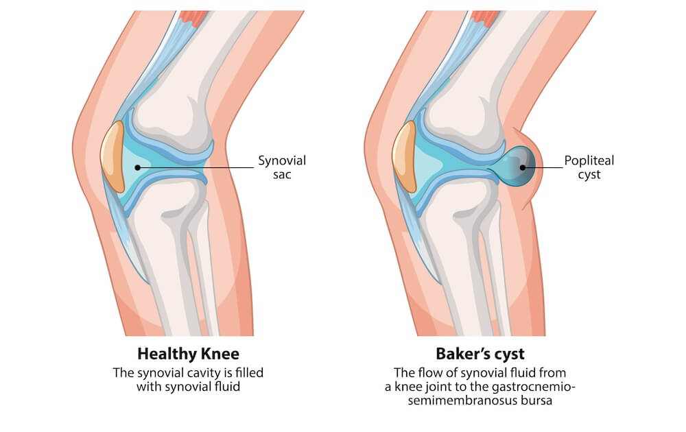 Medisinsk illustrasjon som sammenligner et friskt kne med et kne som har Bakers cyste, vist i profil. Den venstre figuren viser et friskt kne med en normal leddkapsel fylt med leddvæske, merket som "Synovial sac". Den høyre figuren viser hvordan leddvæske har strømmet ut og dannet en kul i knehasen, en såkalt Popliteal cyste eller Baker's cyste.