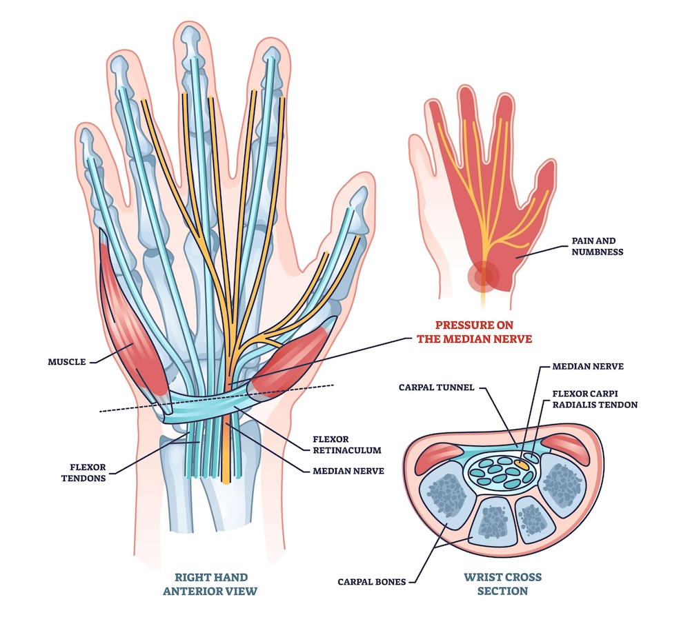 Medisinsk illustrasjon som forklarer karpaltunnelsyndrom gjennom tre anatomiske visninger av en høyre hånd. Hovedmotivet viser hånden sett forfra med sener, muskler og mediannerven som går gjennom håndleddet under et bånd som heter flexor retinaculum og som danner den såkalte karpaltunnelen. Illustrasjonen øverst til høyre markerer områder med smerte og nummenhet i tommel, pekefinger, langfinger og halve ringfingeren med rød farge. Nederst til høyre vises et tverrsnitt av håndleddet som illustrerer hvordan mediannerven ligger i klem i den trange karpaltunnelen.