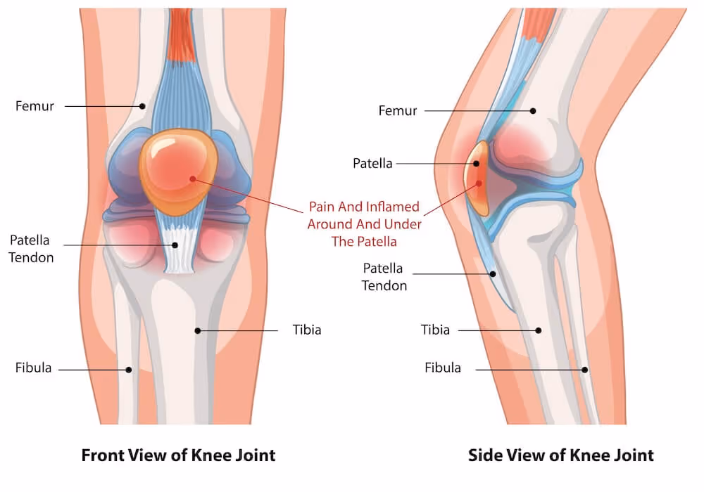 Medisinsk illustrasjon av et kne som viser hevelse og smerte i leddkapselen tilhørende det patellofemorale leddet rundt og bak kneskålen (patellae).