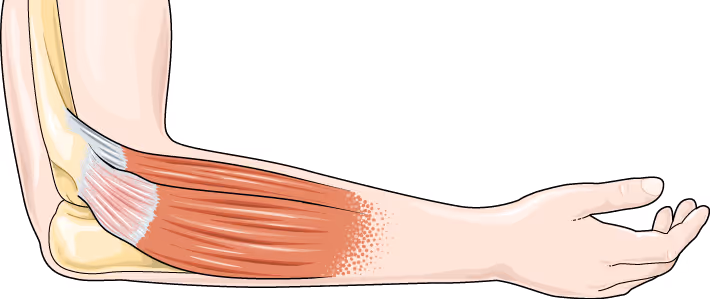 Medisinsk illustrasjon av en bøyd albue, sett fra siden, som viser muskulaturen og senefestet på utsiden av albuen hvor ekstensorsenene fester seg. Senen er lett rød for å illustere irritasjon og viser typiske endringer som oppstår ved tendinopati.