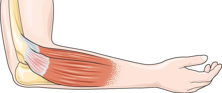 Medisinsk illustrasjon av en bøyd albue, sett fra siden, som viser muskulaturen og senefestet på utsiden av albuen hvor ekstensorsenene fester seg. Senen er lett rød for å illustere irritasjon og viser typiske endringer som oppstår ved tendinopati.