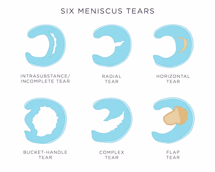 Medisinsk illustrasjon som viser seks ulike typer avrivninger i menisken sett ovenfra.