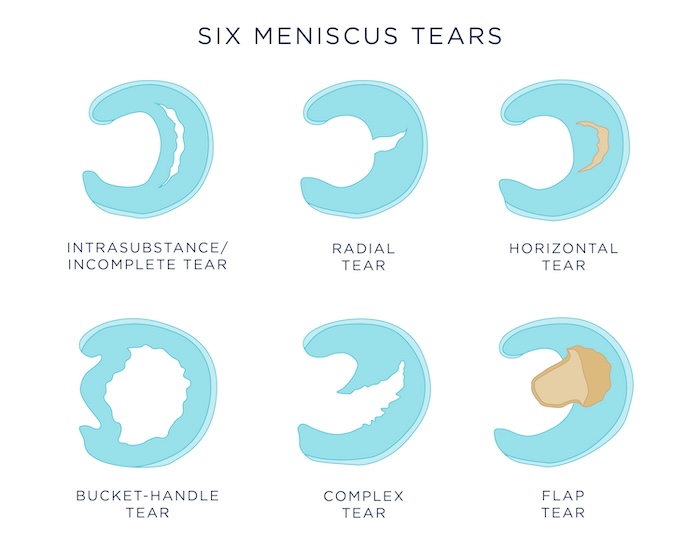 Medisinsk illustrasjon som viser seks ulike typer avrivninger i menisken sett ovenfra.