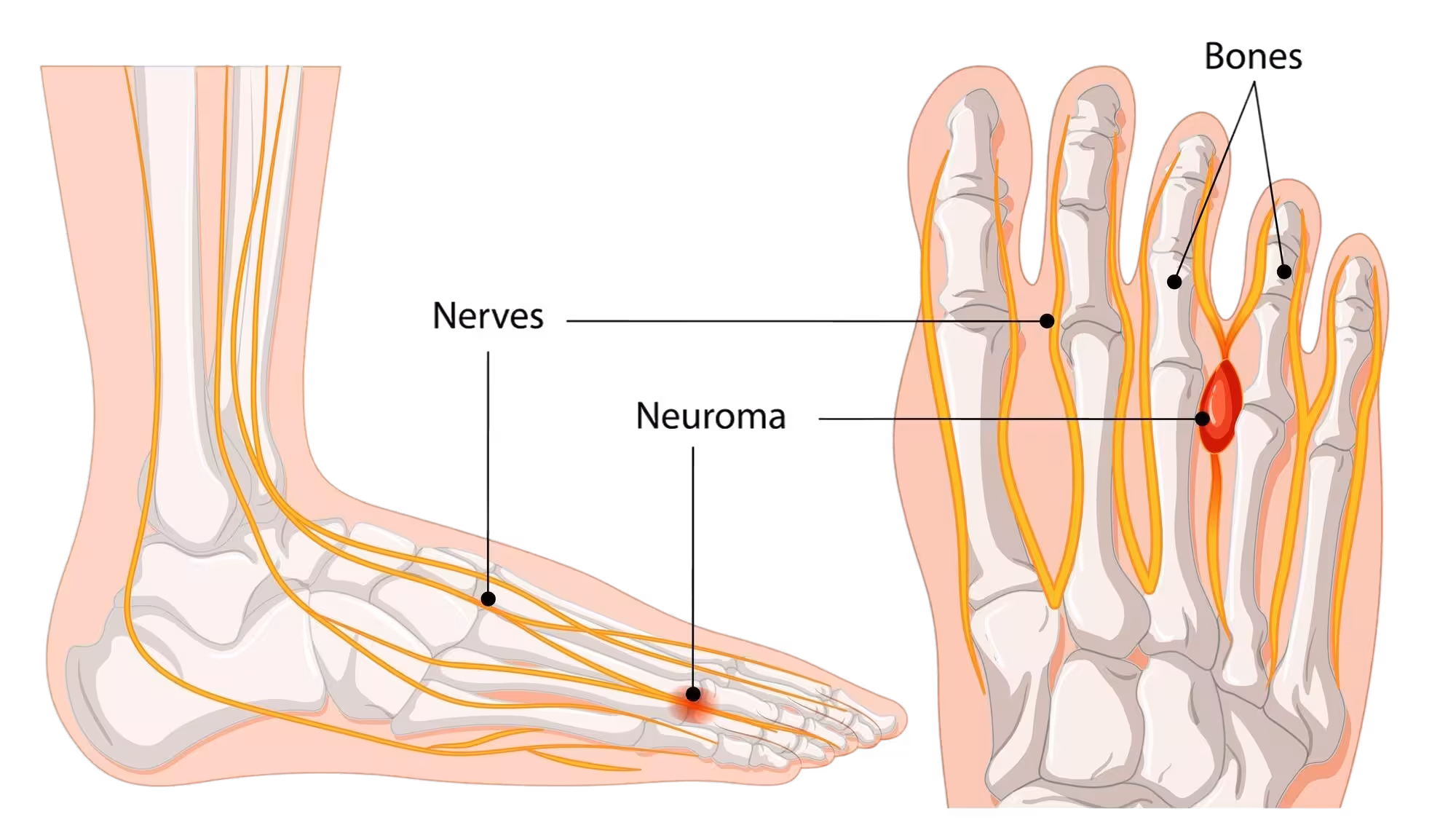 En anatomisk illustrasjon av foten som viser plasseringen av Mortons nevrom. Bildet til venstre viser foten fra siden med skjelettstrukturene og nervene som kommer fra leggen og går langs fotbuen og fram til tærne. Bildet til høyre viser foten ovenfra og viser metatarsalbena (mellomfotsbena) og falangene (tåbena), og nervene som går mellom. Nervene er representert som gule linjer, og lokalisasjonen til Mortons nevrom er markert som en rød, fortykket nerveklump plassert mellom metatarsalhodene til tredje og fjerde tå.