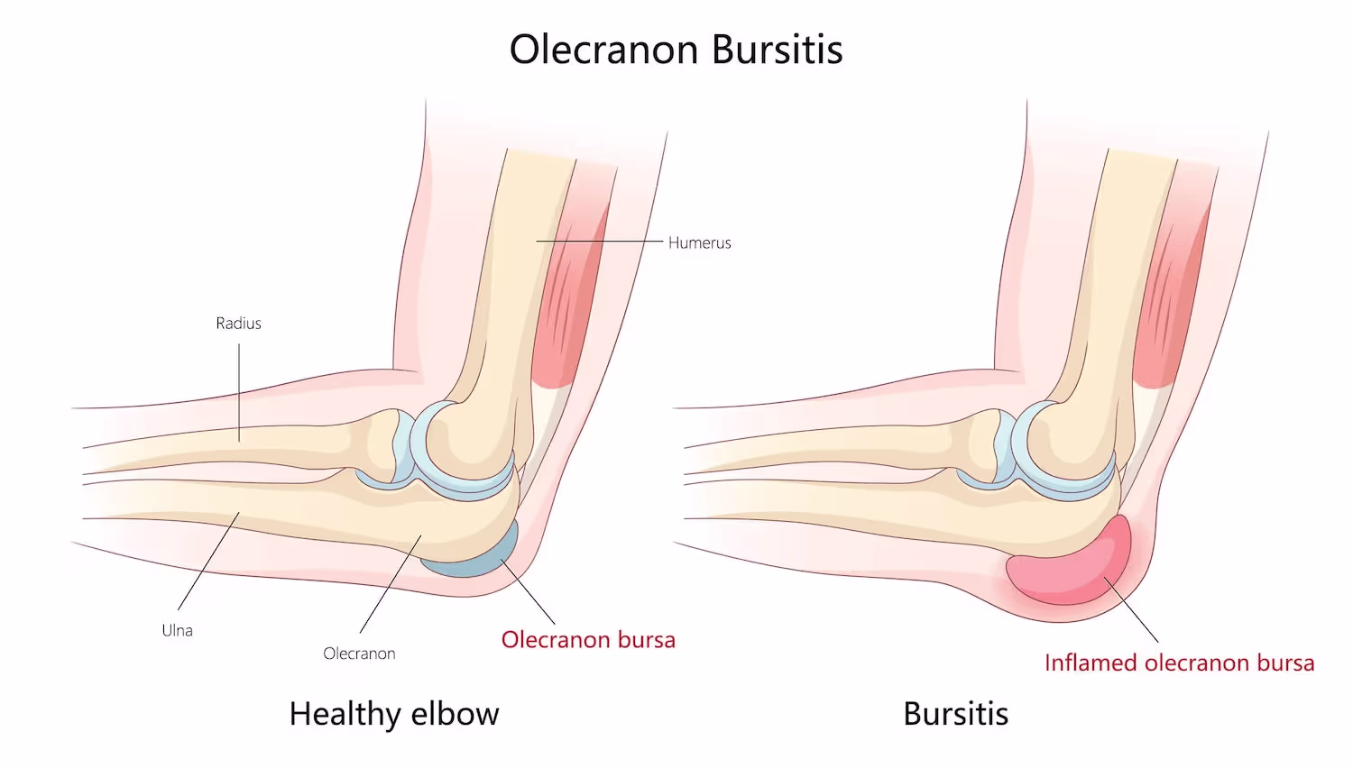 Medisinsk illustrasjon som sammenligner en frisk albue og en albue med olecranonbursitt (slimposebetennelse). Venstre side viser normal anatomi med humerus, radius, ulna, olecranon og en liten, normal olecranonbursa. Høyre side viser en tydelig forstørret og betent olecranonbursa bak på albuespissen — typisk for olecranonbursitt.