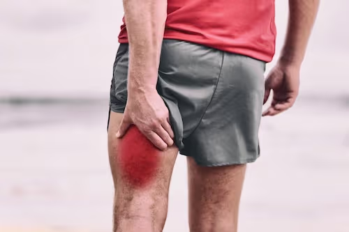 Illustrasjon av løper som holder seg til baksiden av låret, med et rødt område som markerer smertepunktet – typisk for muskelstrekk i hamstring.