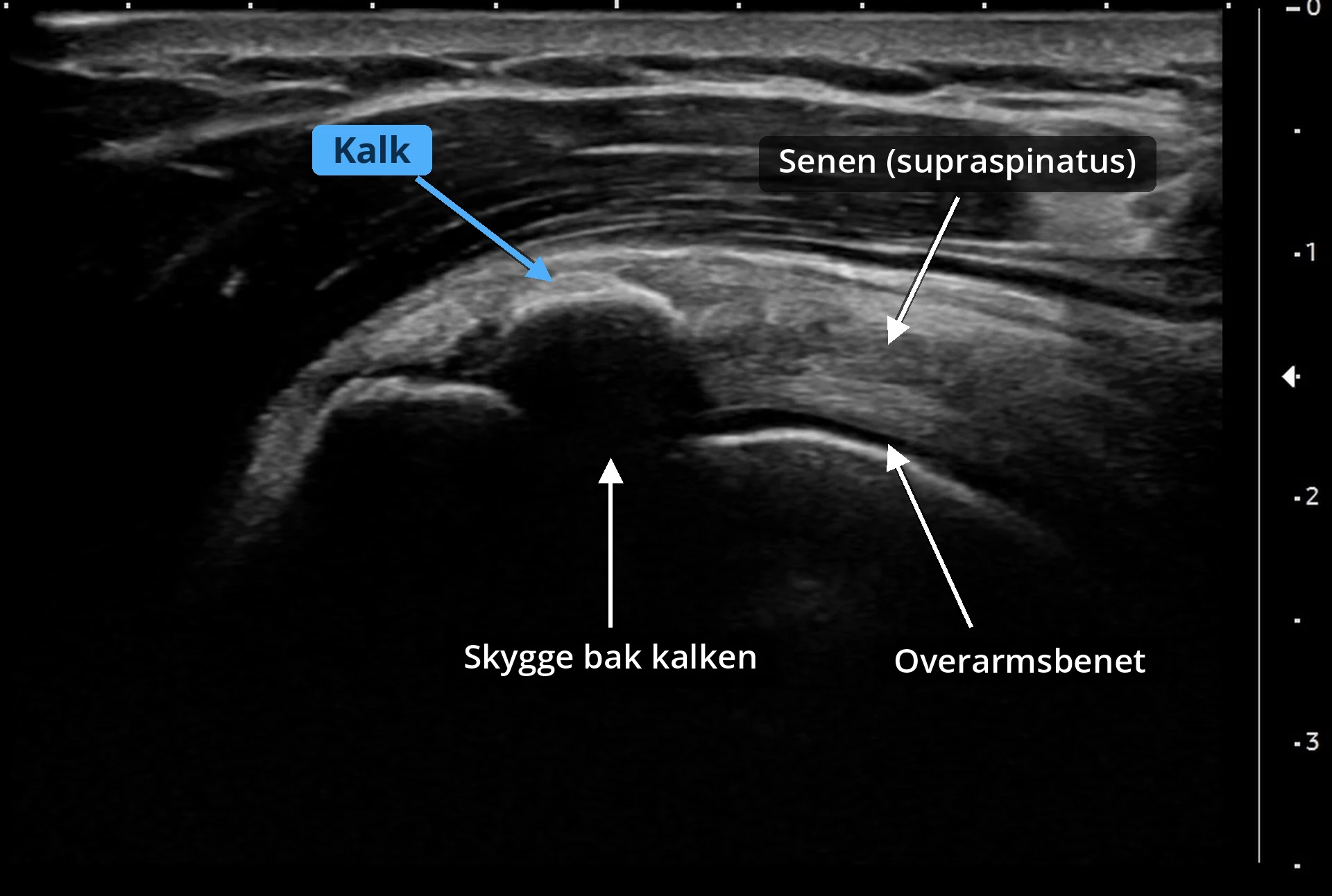 Ultralydbilde av kalk i skulderen (kalkskulder) som viser en avgrenset kalkavleiring i supraspinatussenen med akustisk skygge over overarmsbenet.