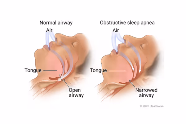 Sleep Apnoea: What is it? And What is the Best Apnoea Treatment?