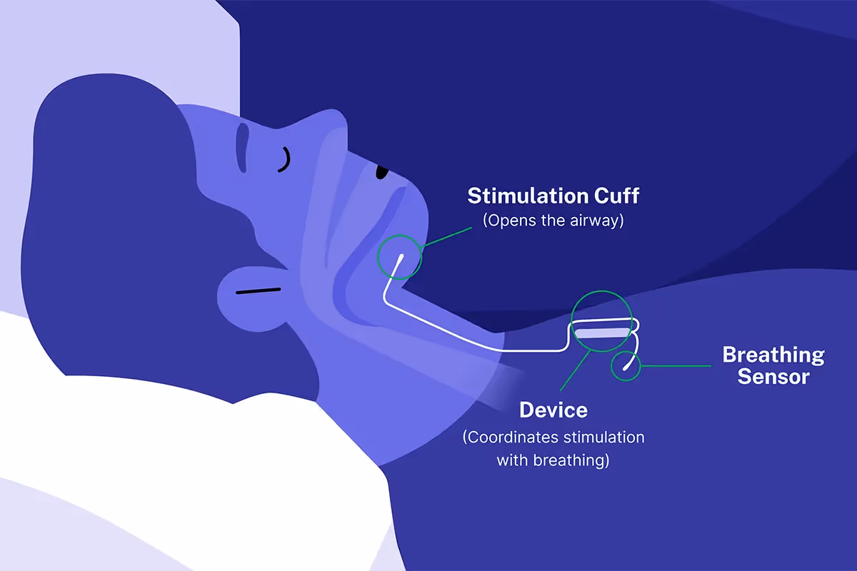 Thinking of Inspire Surgery for Sleep Apnoea?
