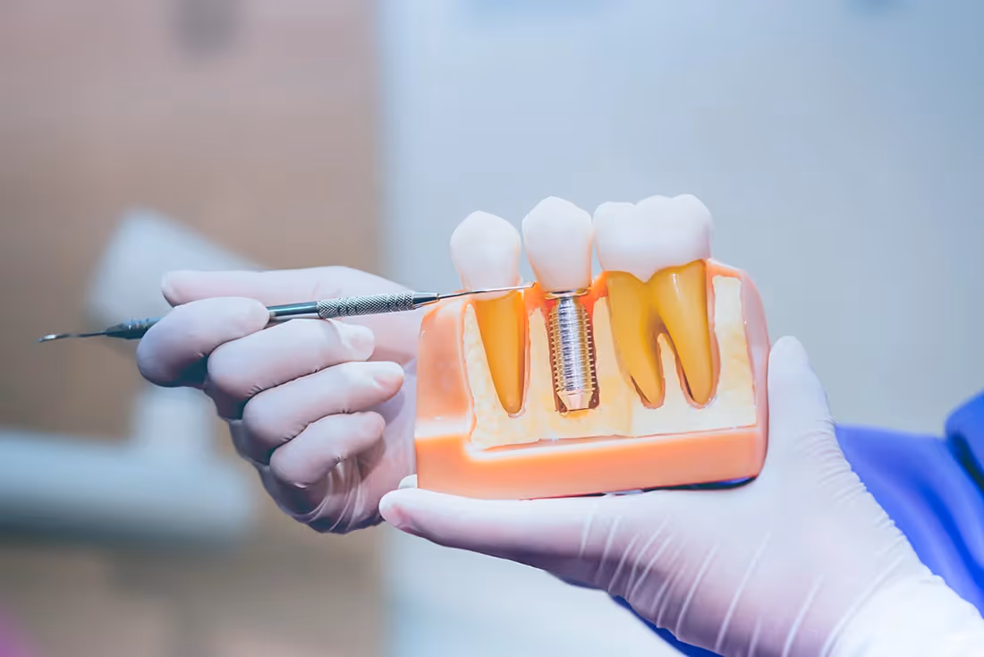 Dental Implants in Boulder