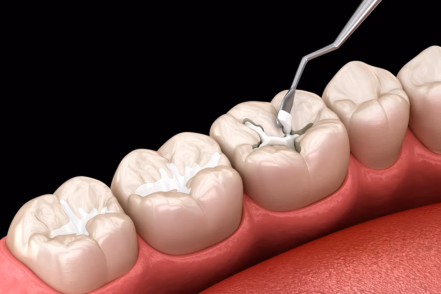 Dental Sealants in Boulder | Folsom Family Dentistry