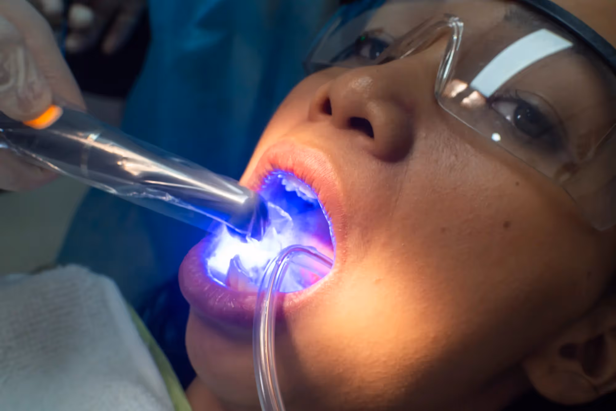 Dental Bonding in Boulder, CO | Folsom Family Dentistry