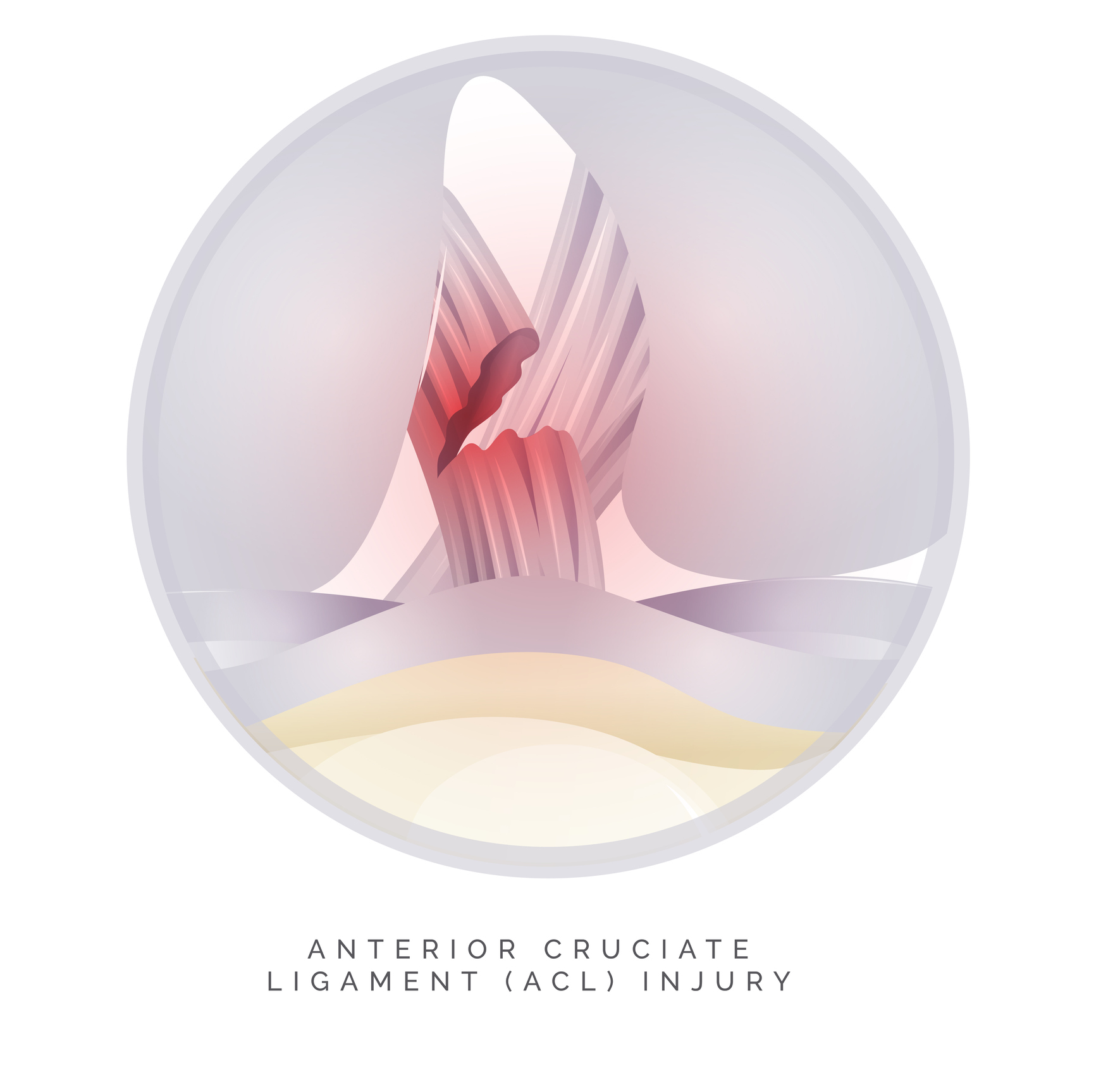 Blog: ACL! The Three Letters No Athlete Wants to Hear