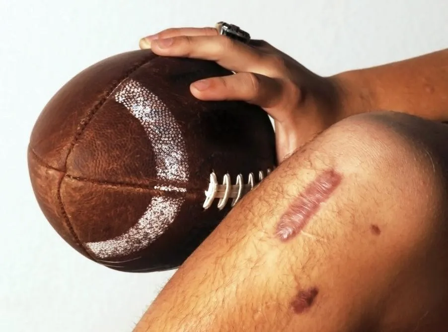 Blog:How do you recover from an ACL tear?