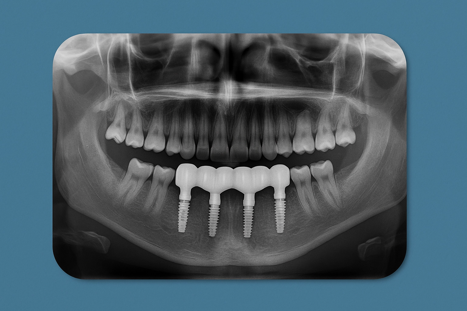 panoramic dental x-ray showing lower jaw with four titanium implants supporting bridge, clear bone and teeth structure, blue grey background