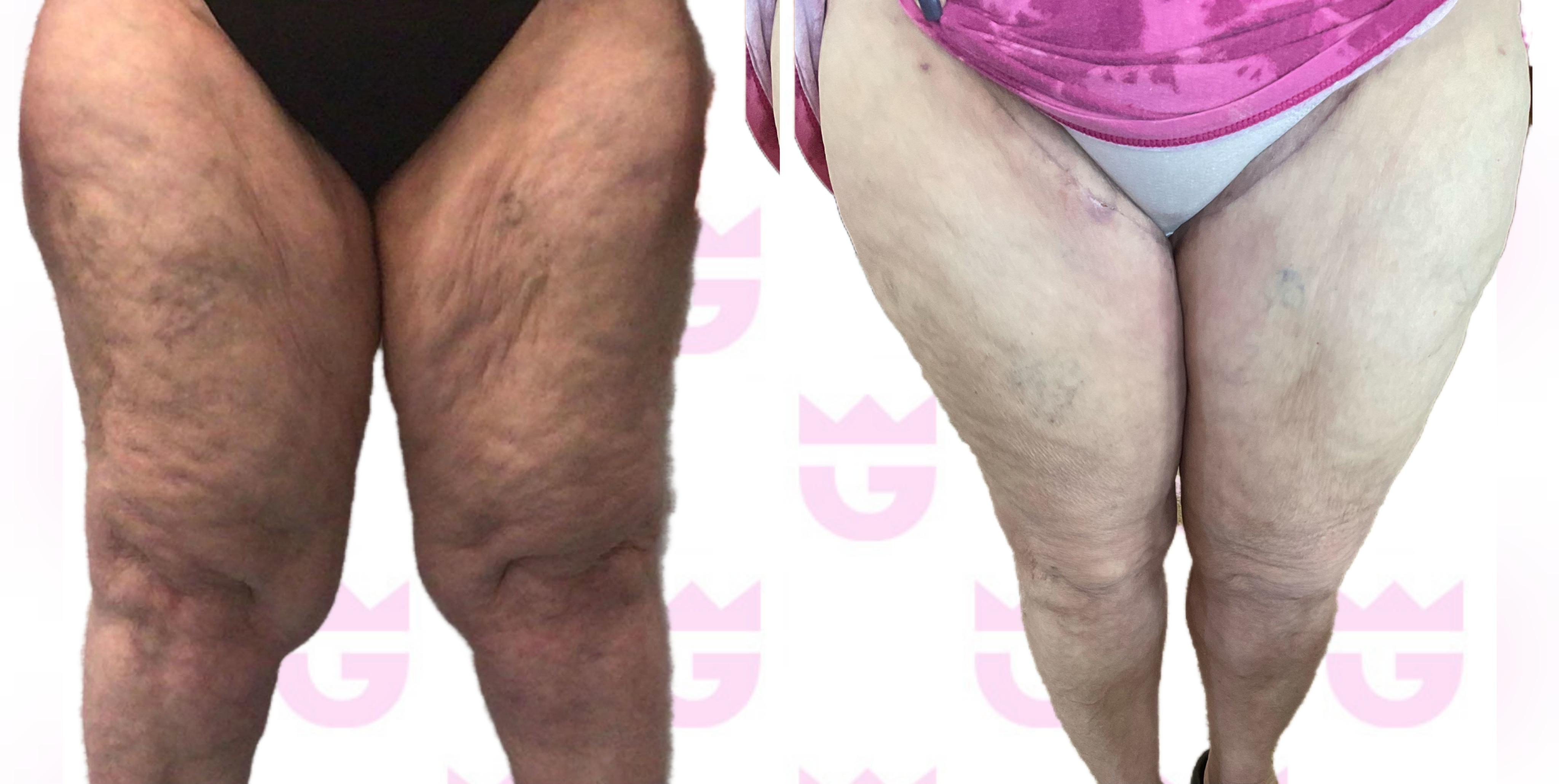 Thigh Lift Gallery