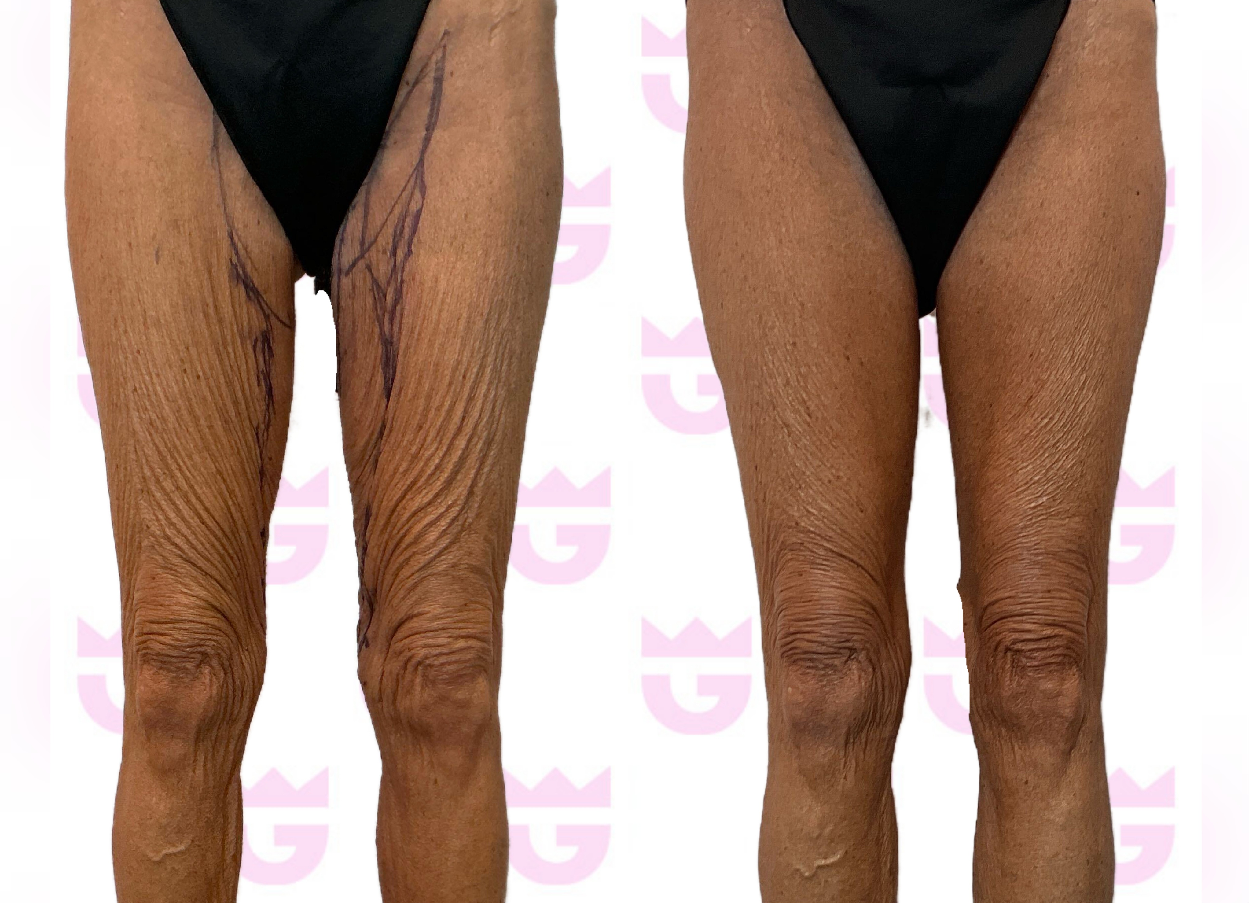 Thigh Lift Gallery