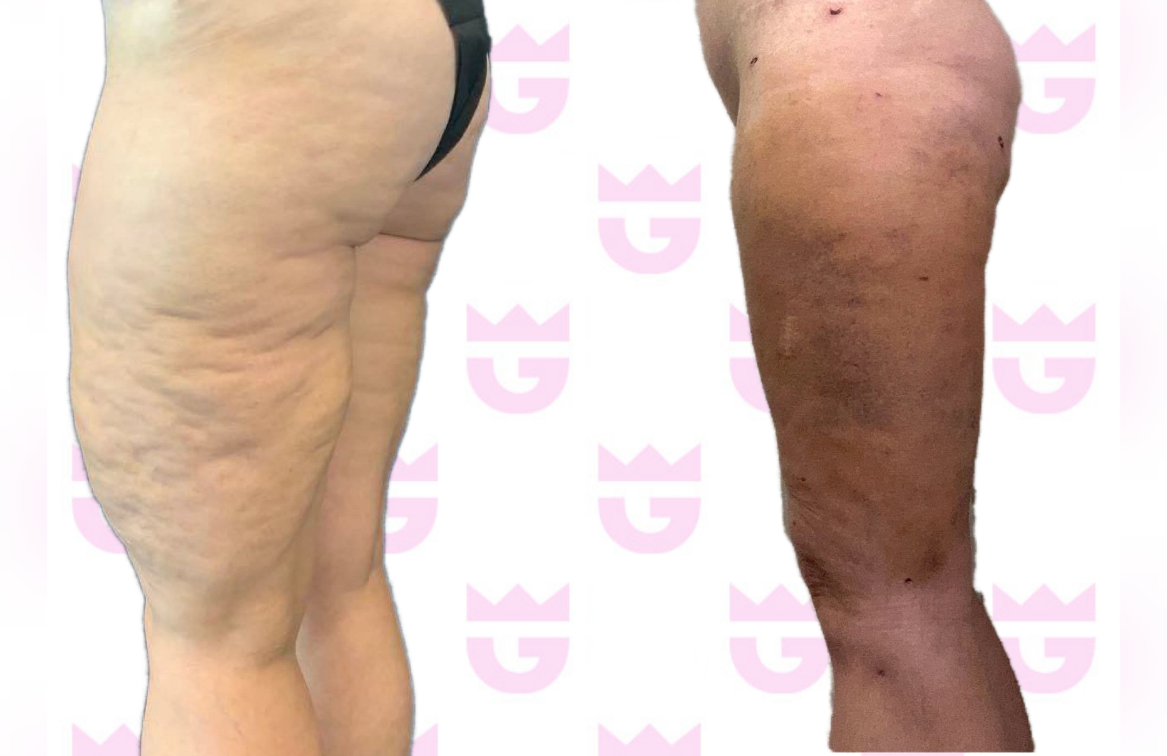 Thigh Lift Gallery