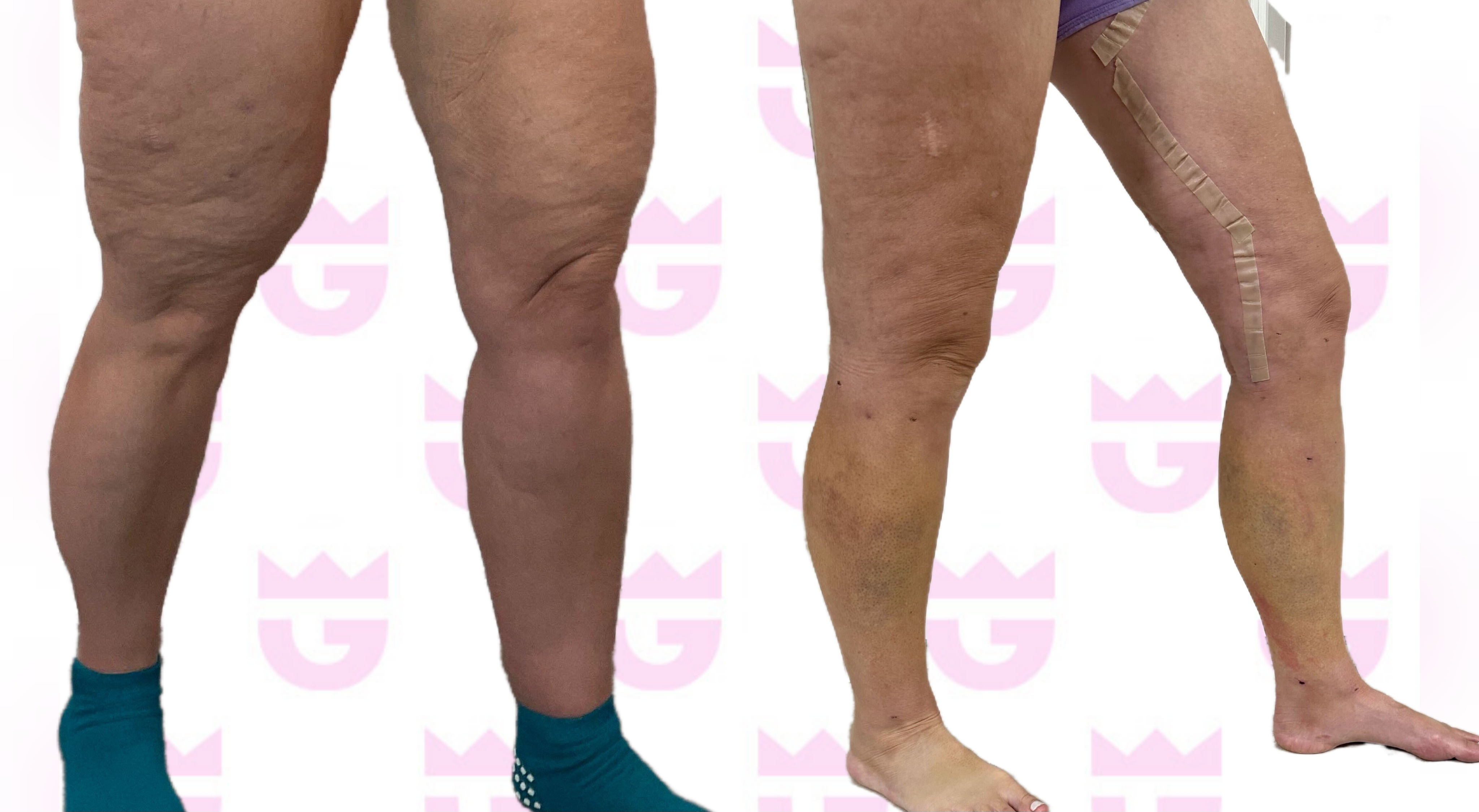 Thigh Lift Gallery