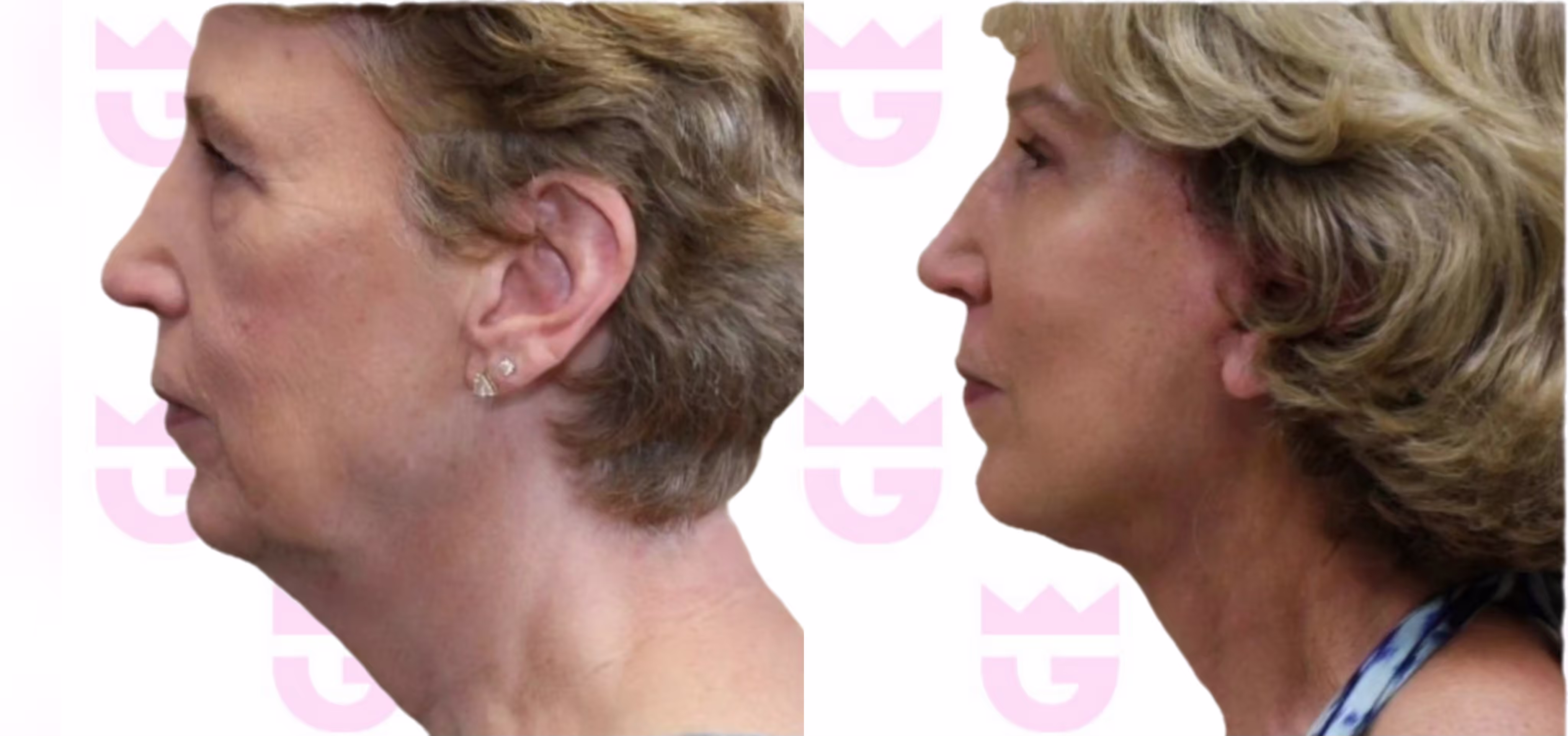 Neck Lift Gallery