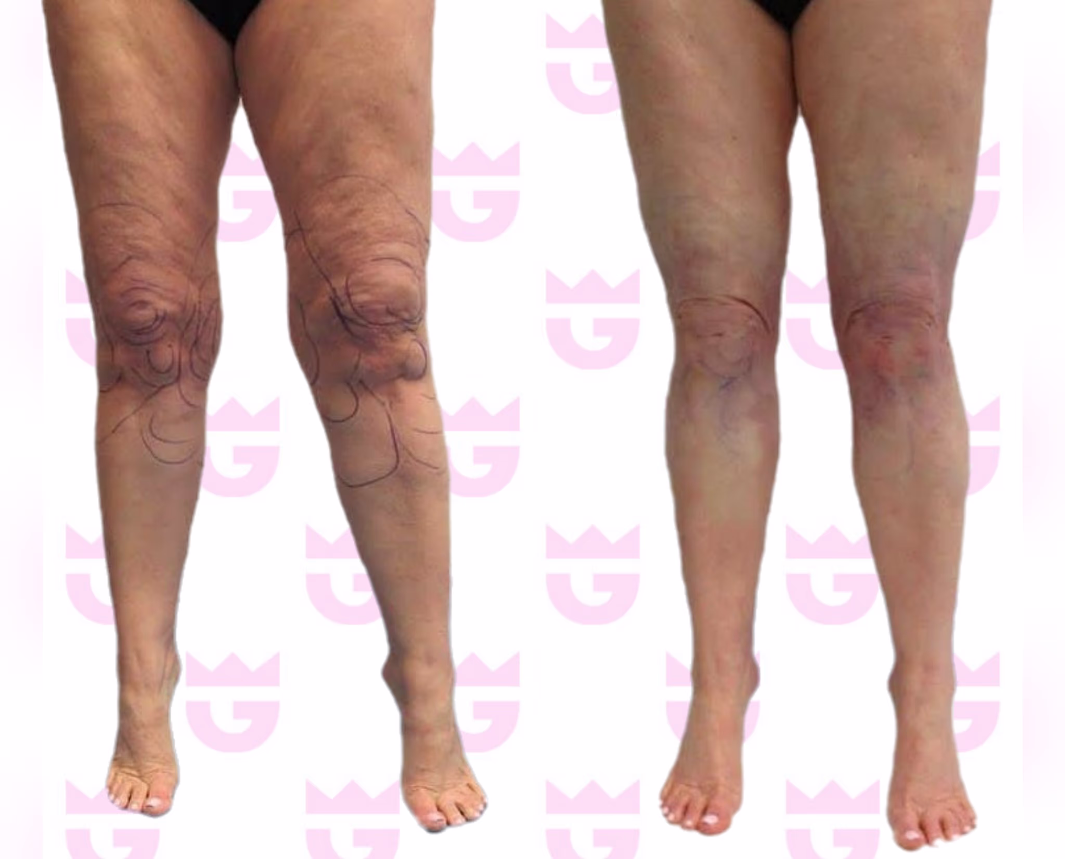 Calf Liposuction Gallery