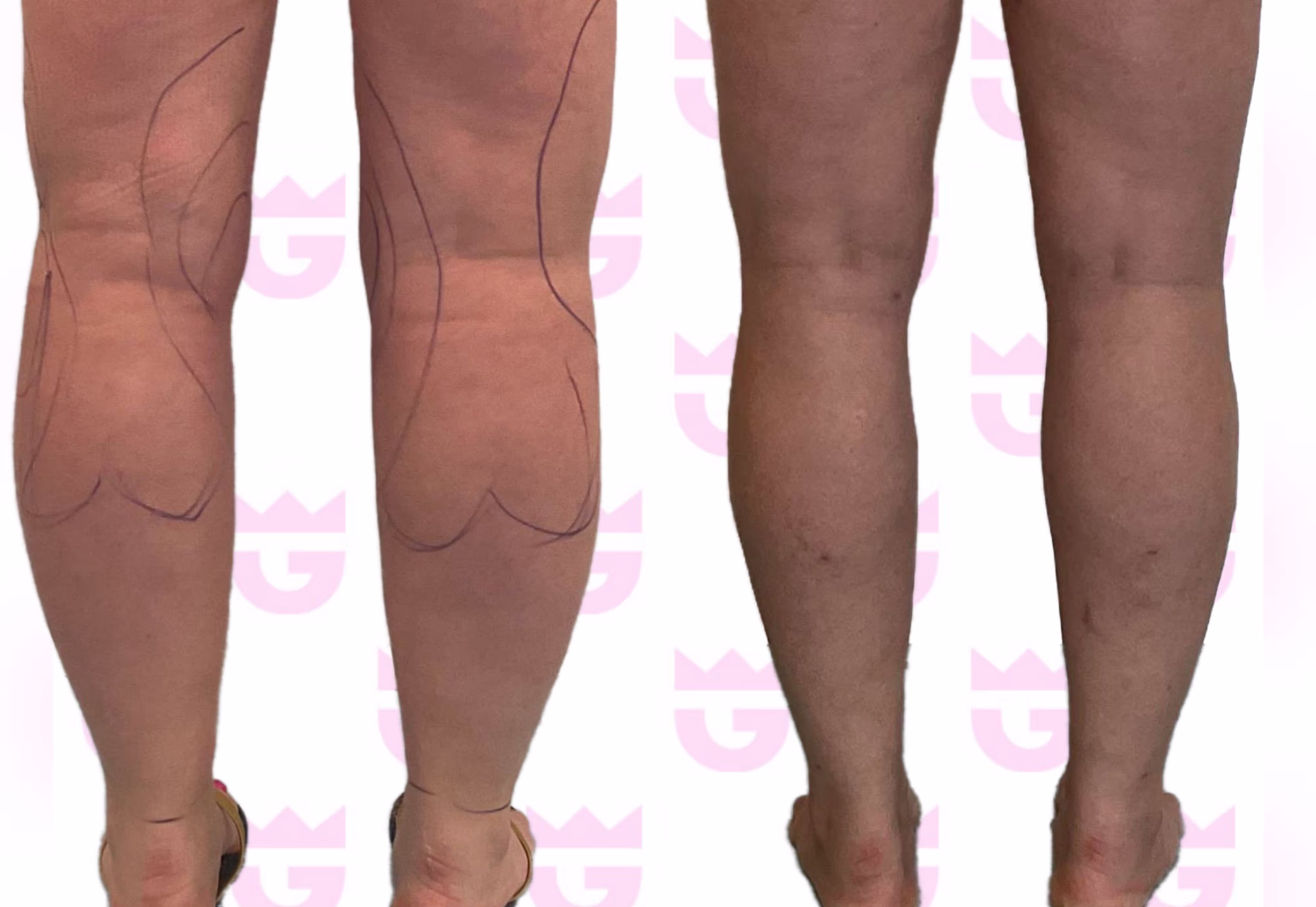 Calf Liposuction Gallery